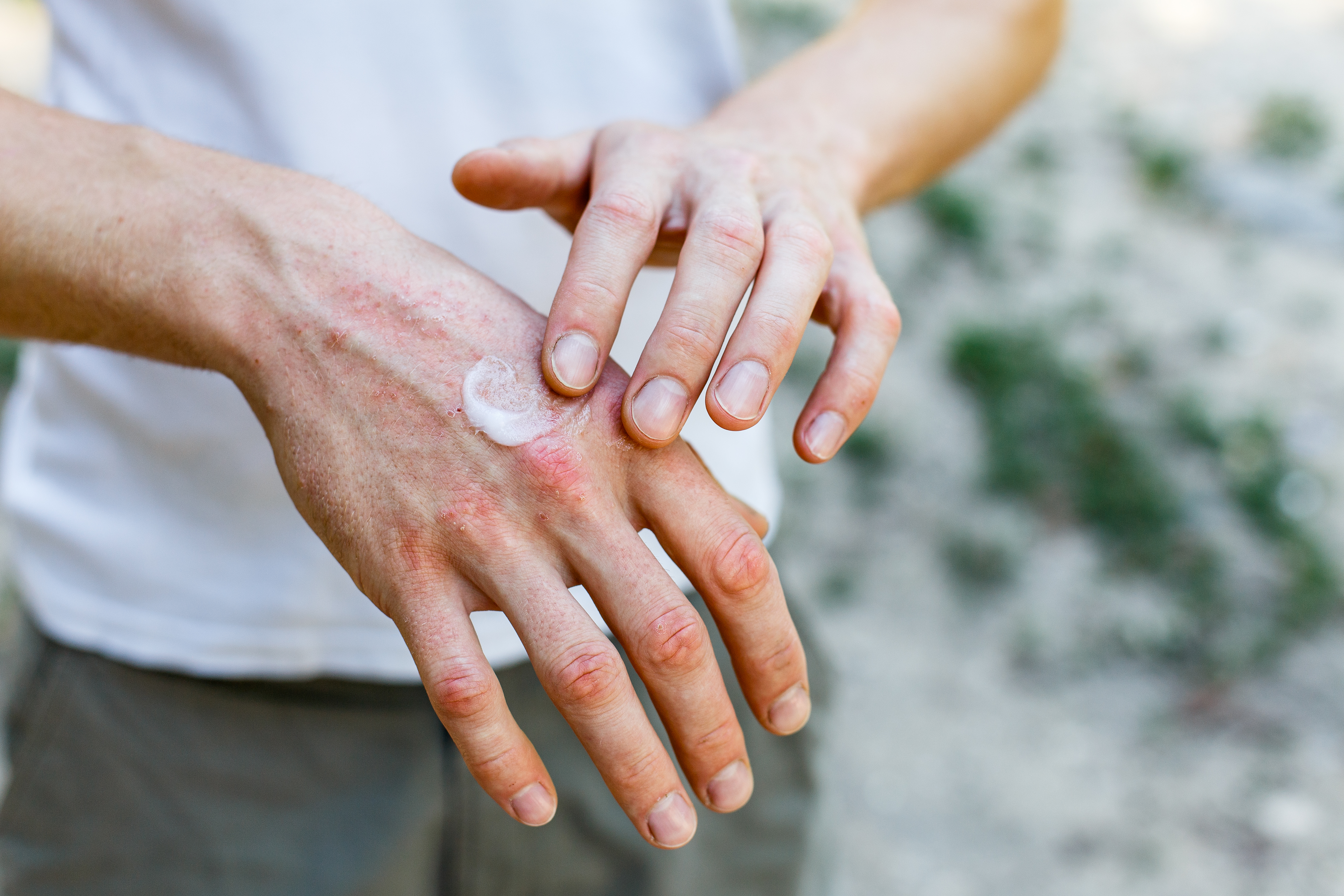 How nutritional therapy may help with eczema